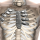 Illustration for article titled For the first time, a fully 3D printed Titanium sternum and partial ribcage has been implanted into a patient.
